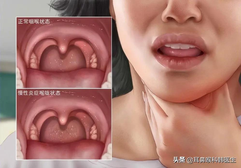 咽干咽痒、咽异物感......慢性咽炎真是让人备受折磨