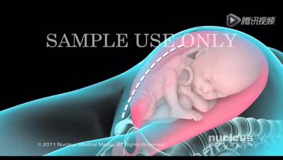 顺产怕侧切和撕裂怎么办,顺产侧切好过剖宫产吗