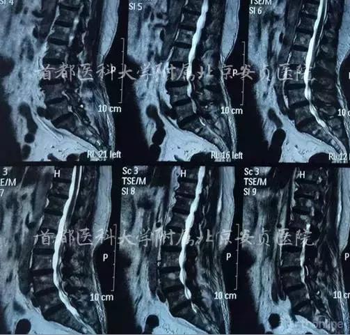 颈椎病引起的胸闷胸痛在哪个部位,颈椎病会引起咳嗽胸闷胸痛吗