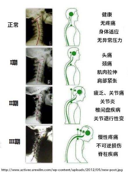 晃头颈椎有咔咔响声的危害,颈椎咔咔响是什么型颈椎病