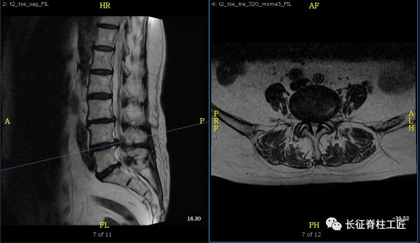 老年人腰椎管狭窄可以微创手术吗,老年人腰椎管狭窄瘫痪
