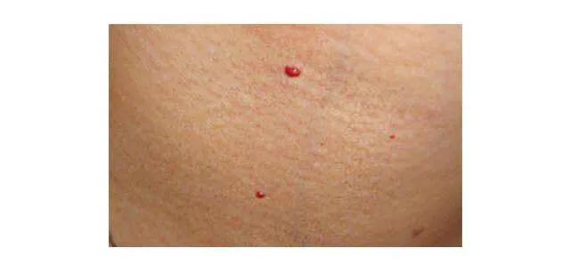 得了乙肝的人身上长红点怎么回事,乙肝病毒携带者身上有一颗颗红点