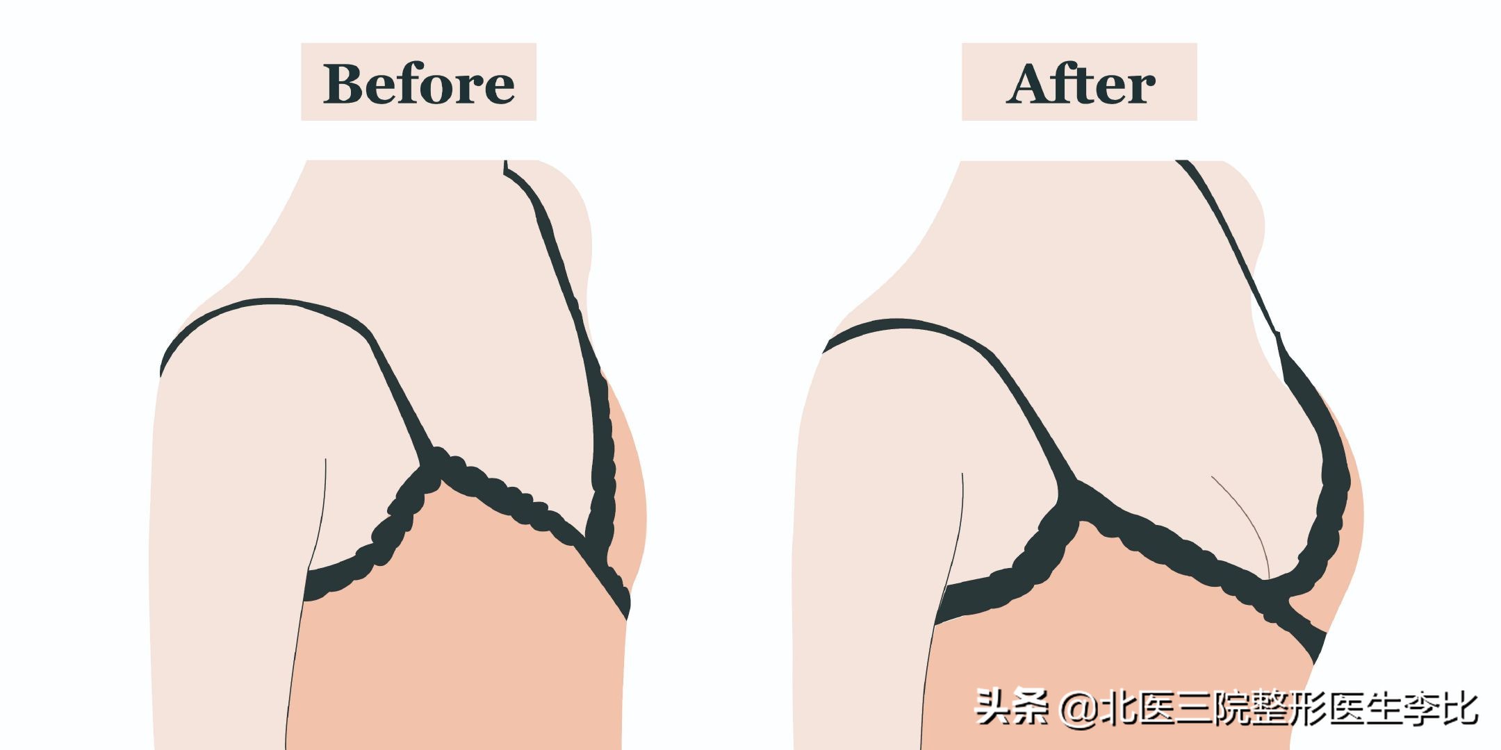 丰胸最有效的四大方法,目前丰胸最靠谱的方法