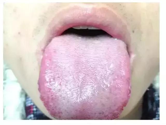 观舌识病22种舌诊图解大全,舌诊看舌头视频