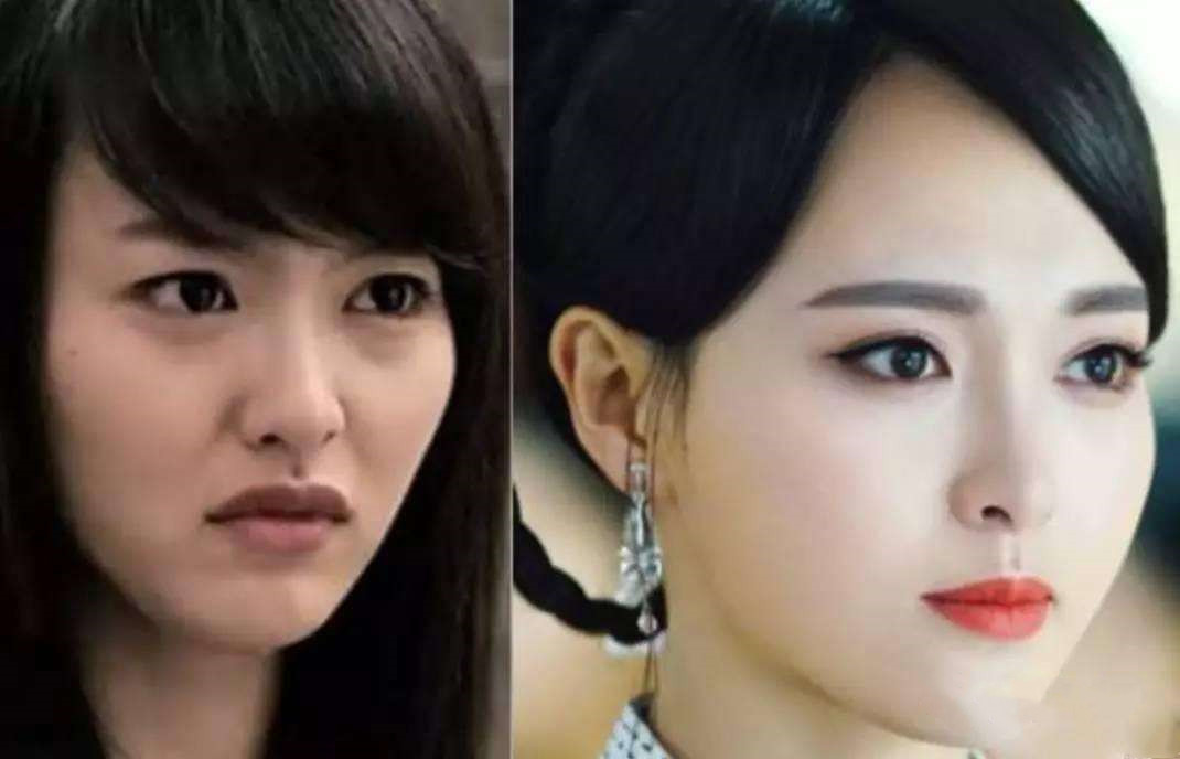 法令纹填充玻尿酸显老,玻尿酸填充法令纹显老怎么办