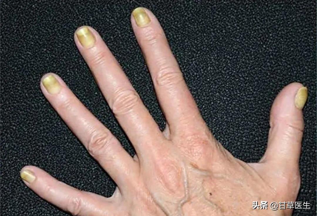 指甲出现这几种变化可能是肿瘤,心血管疾病指甲有变化吗