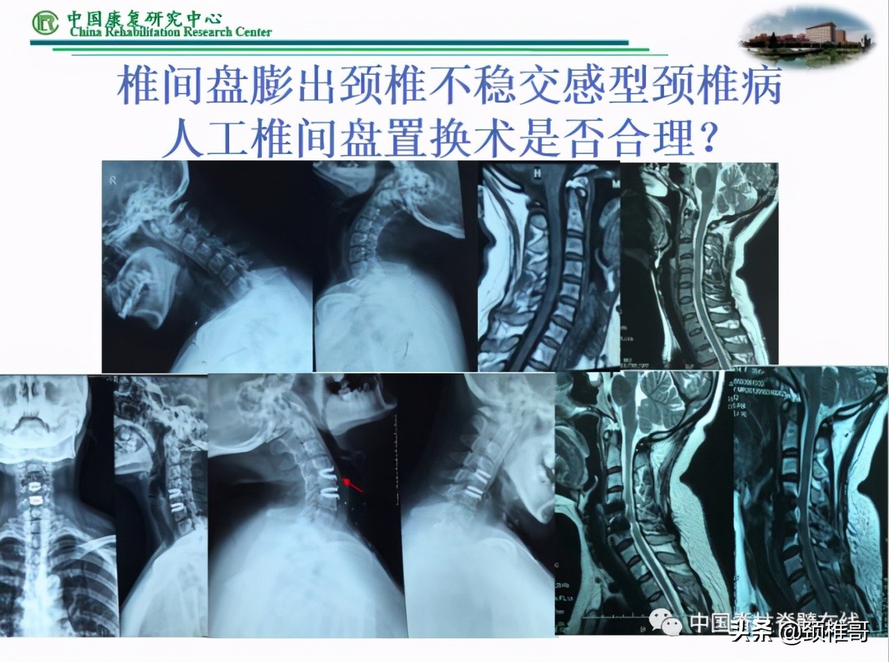 颈椎病的护理临床路径流程图,颈椎病的健康管理与康复指导
