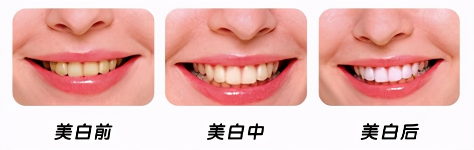 皓齿美白费用要多少,皓齿美白需要做几次