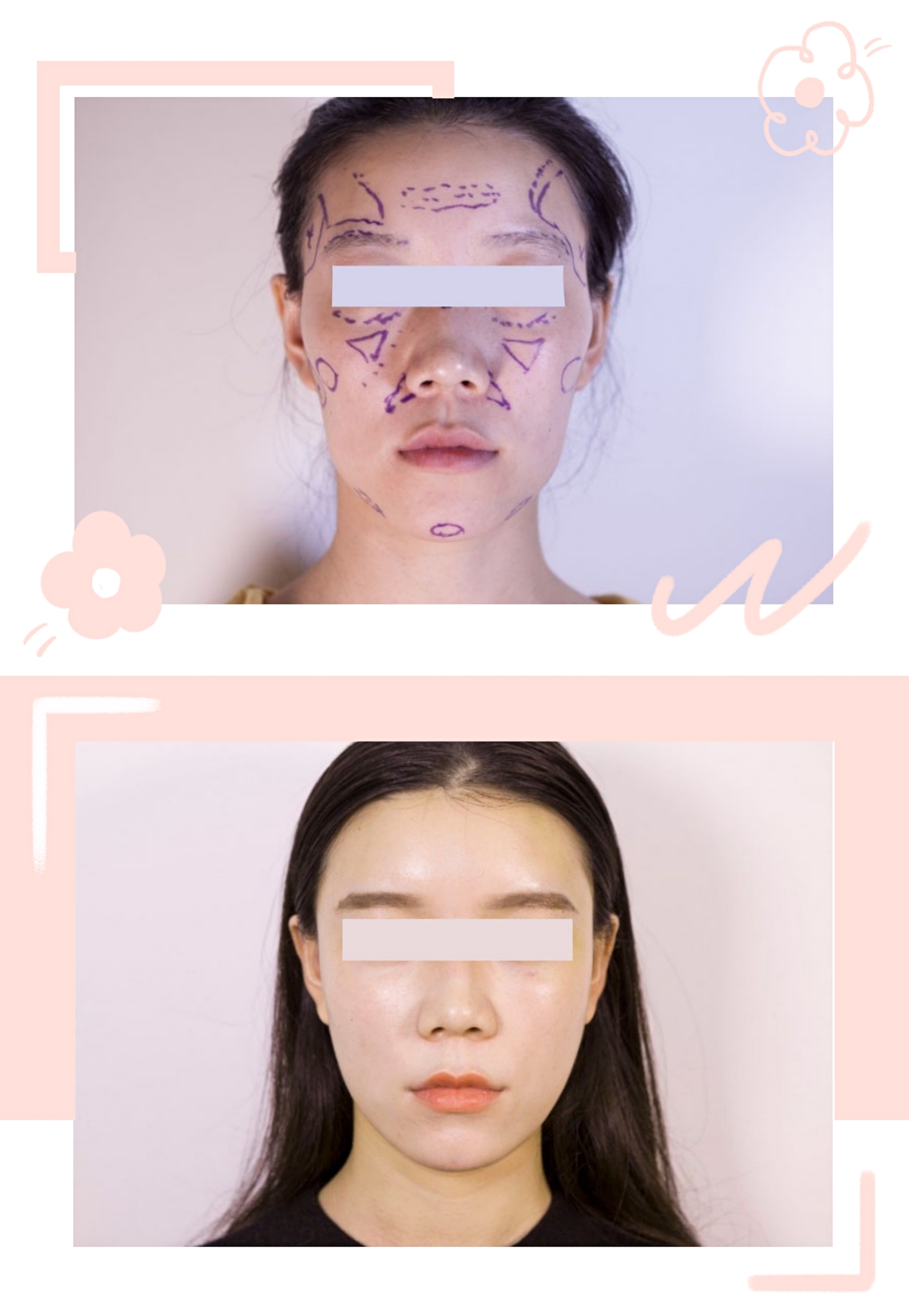 泪沟自体脂肪填充永久,自体脂肪填充太阳穴可以永久吗