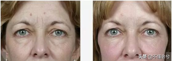 做提拉紧致的护肤有副作用吗,紧致提拉做美容有效吗