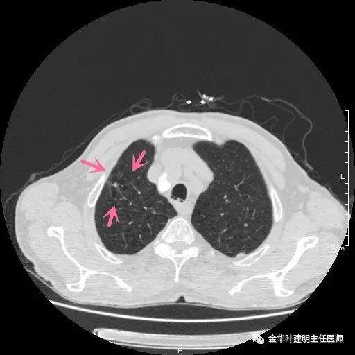 多发原发肺癌能根治吗,肺部原发性恶性肿瘤好治