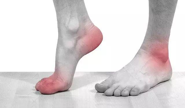 尿酸高的人不喝酒会尿酸高吗,尿酸高的人注意这四点