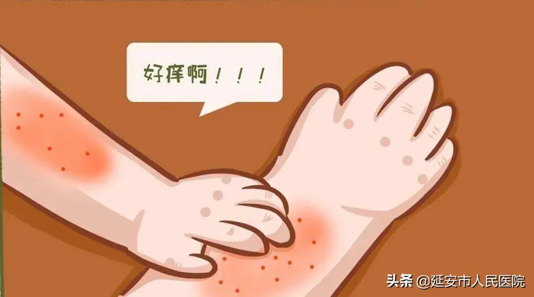 痒到怀疑人生,痒到钻心的湿疹是哪一种