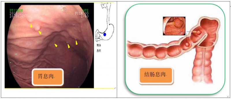 内镜下摘除息肉后几天能走路,内镜摘除肠胃息肉后饮食
