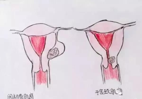 医生精美手绘图片大全,宫颈息肉红蓝铅笔手绘图