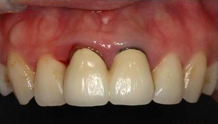 全烤瓷牙有什么风险和后遗症,做烤瓷牙有什么危害