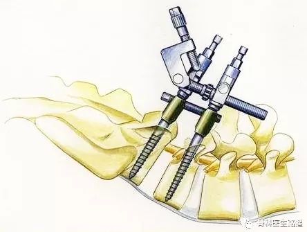 鑵版闂寸洏绐佸嚭鑳芥牴娌讳箞,鑵版闂寸洏绐佸嚭鐥囩姸琛ㄧ幇