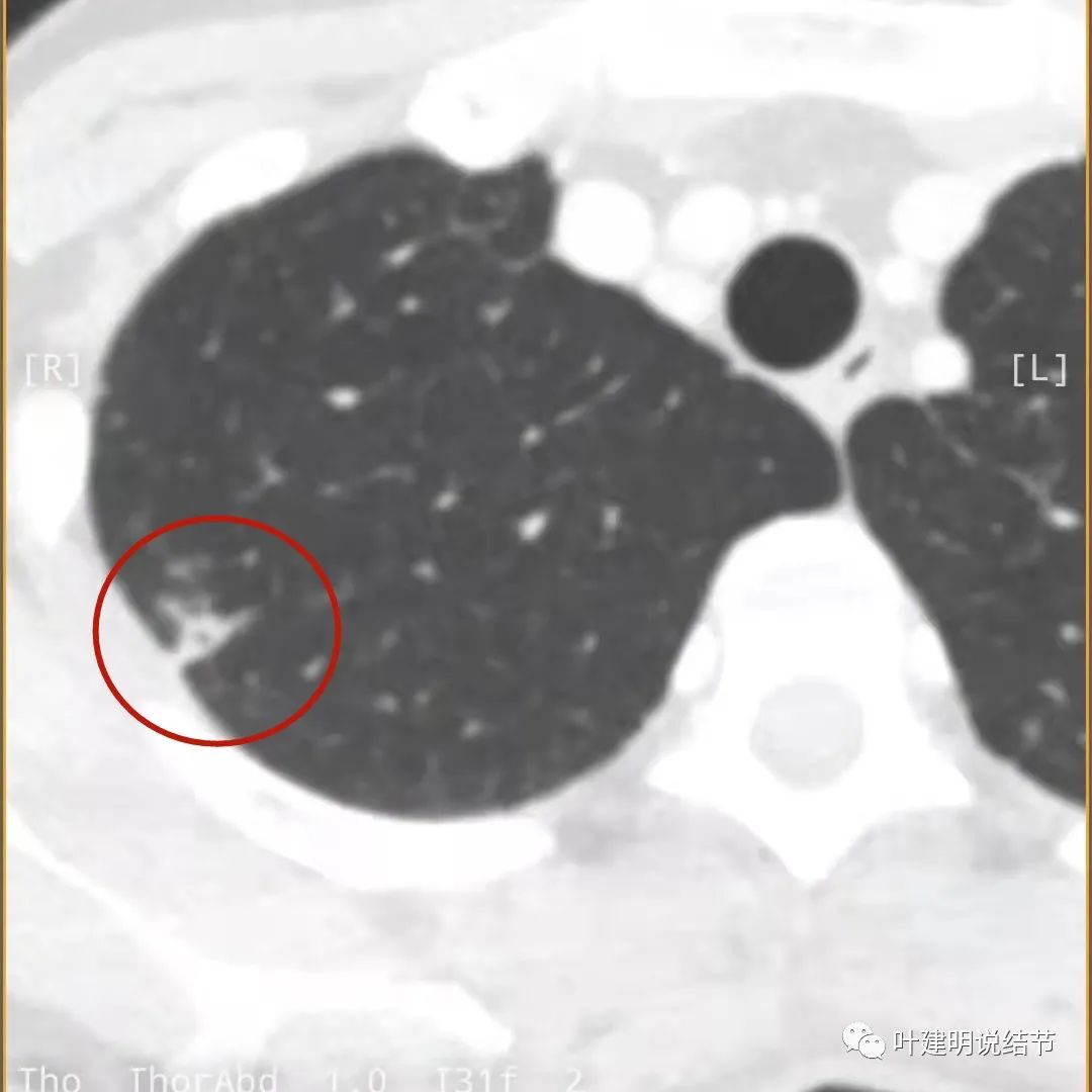 临床诊断孤立性肺结节,空洞型结节一般是什么性质