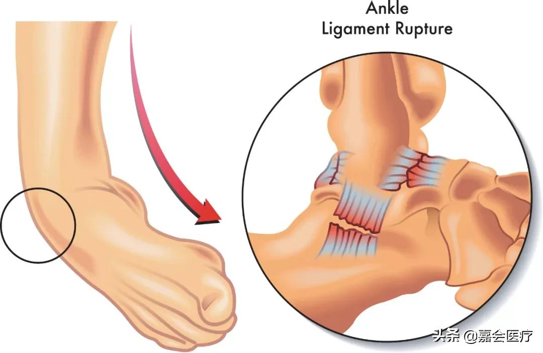 脚踝损伤后如何防止摔倒,常见脚踝损伤的预防与处理