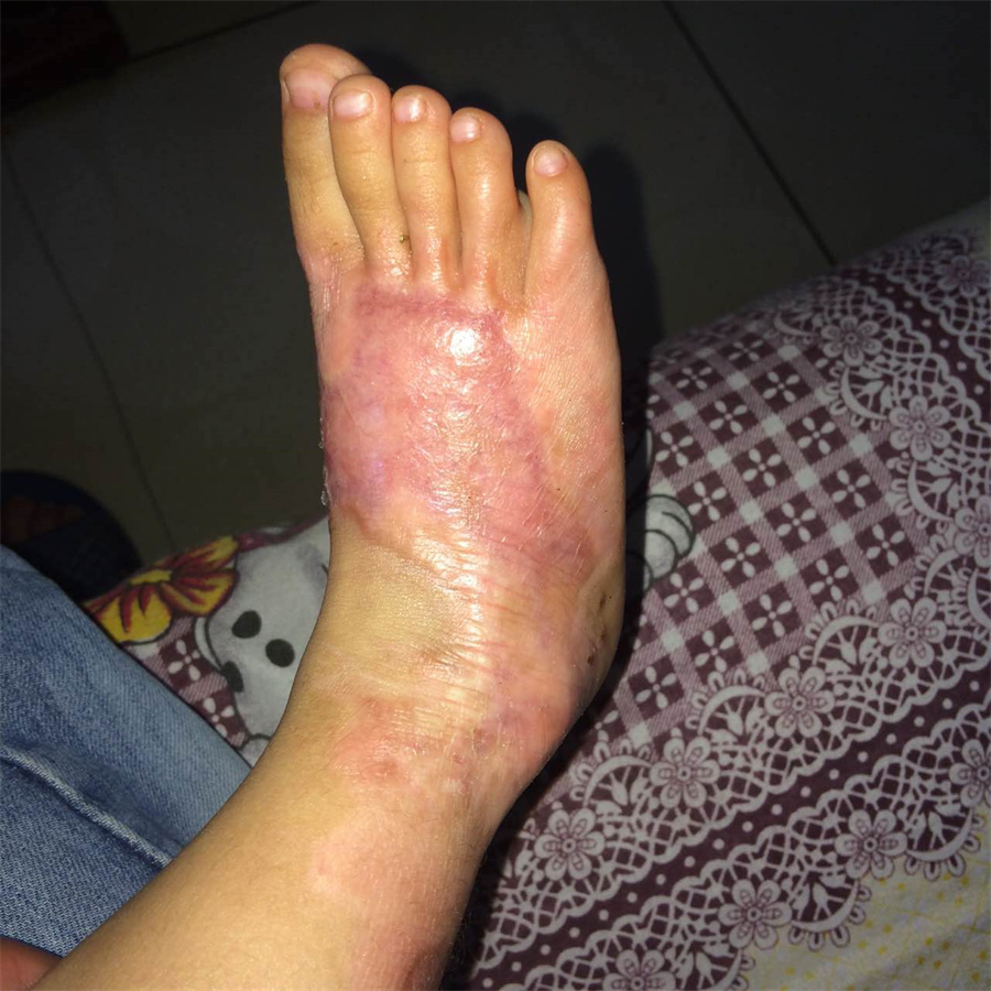 妈妈不小心被女孩烫伤,孩子被烫伤记住四件事情