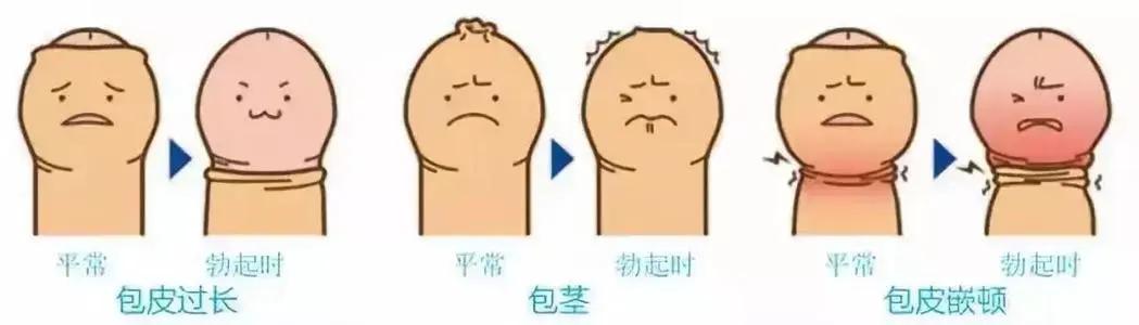 包皮包茎存隐患，生殖健康需关注