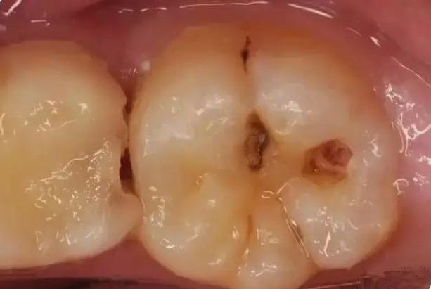 牙疼引起神经疼怎么治疗,牙疼引起牙齿疼痛怎么办