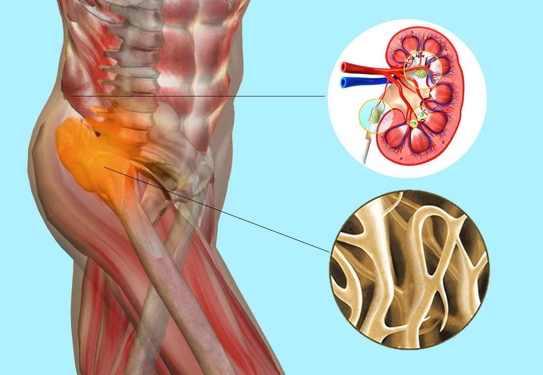 当肾结石遇上了骨质疏松，你知道该怎么补钙吗？