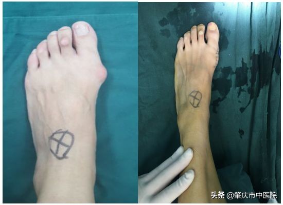 原来脚拇趾外翻是一种病，“元凶”竟是经常穿这种鞋有关！听听市中医院骨伤科专家怎么说……