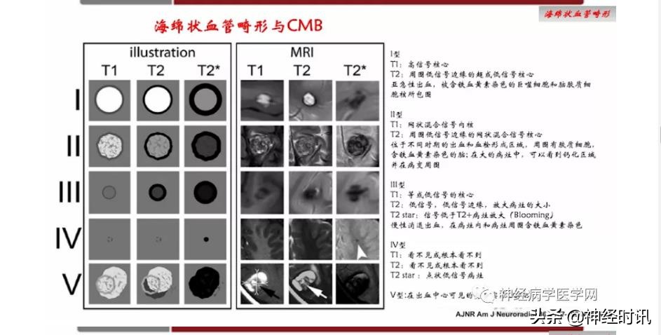 缺血性脑血管病出血评估,脑血管微出血怎么治疗