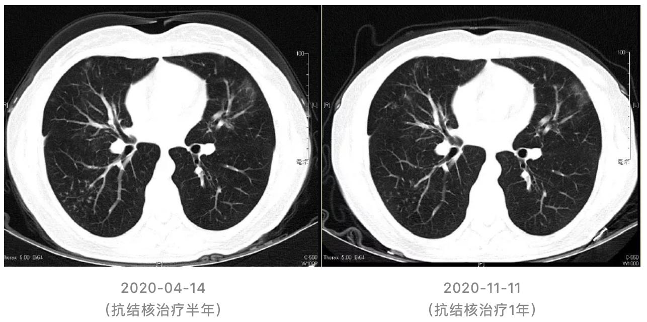 特发性肺炎一直用激素治疗,机化性肺炎住院治疗使用什么药物