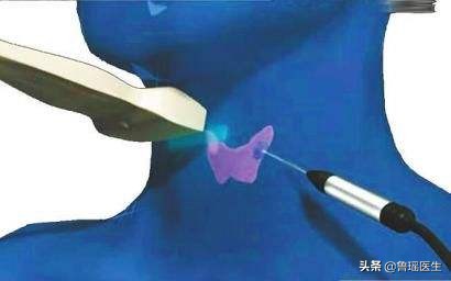 甲状腺癌可以射频消融吗,甲状腺结节是癌能做消融手术吗