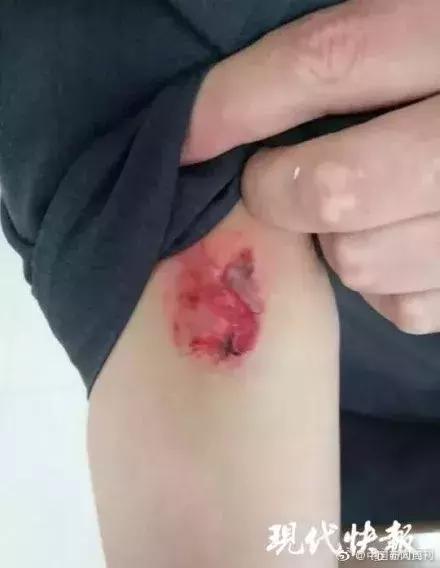 艾滋病人咬伤法官,民警被艾滋病嫌疑犯咬伤