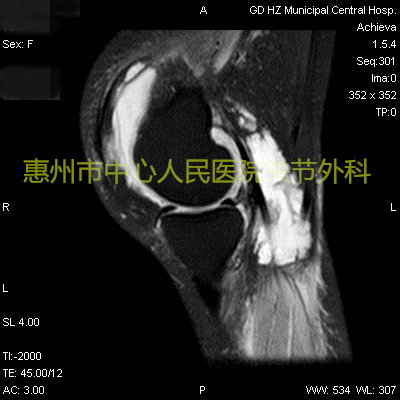 关节炎科普类短视频,化脓性关节炎怎么治疗最好最有效