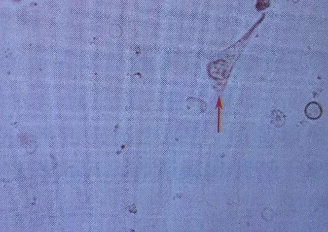 上皮细胞3+什么意思,上皮细胞阳性