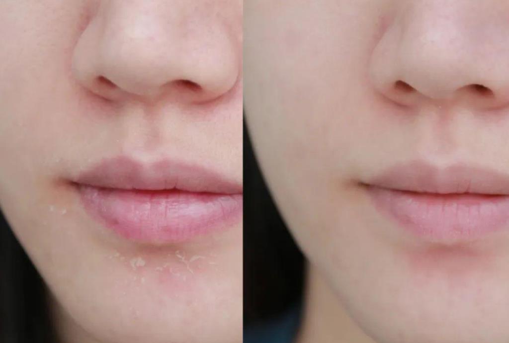 皮肤敏感泛红角质层受损如何修复,改善皮肤泛红敏感肌