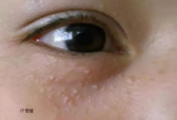 祛除闭合性粉刺软膏有哪些,下巴有闭合性粉刺怎么祛除