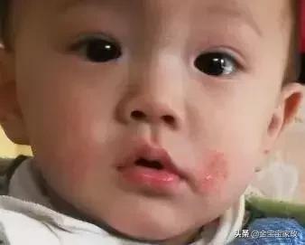 新生儿热疹和湿疹的预防与护理,婴儿湿疹的原因和护理方法