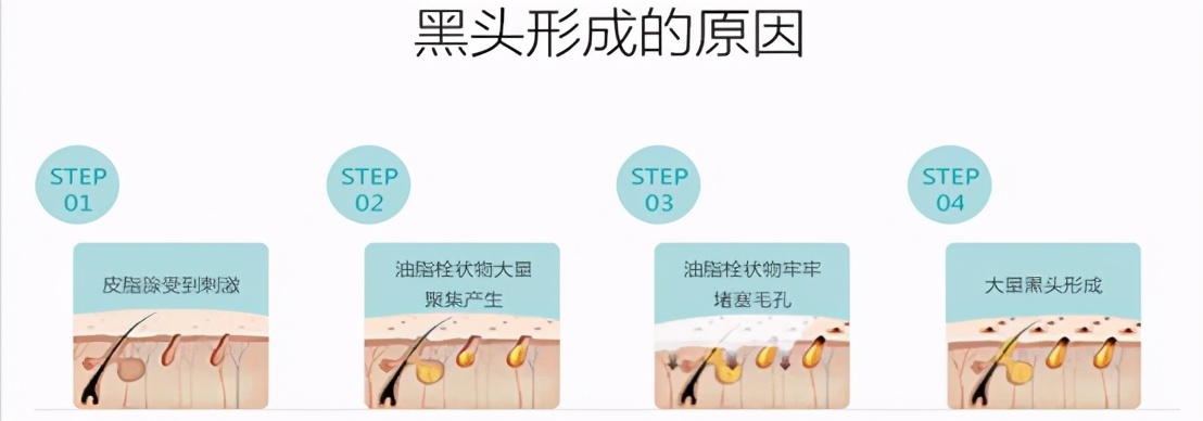 祛黑头一招搞定,祛黑头最好的办法是什么