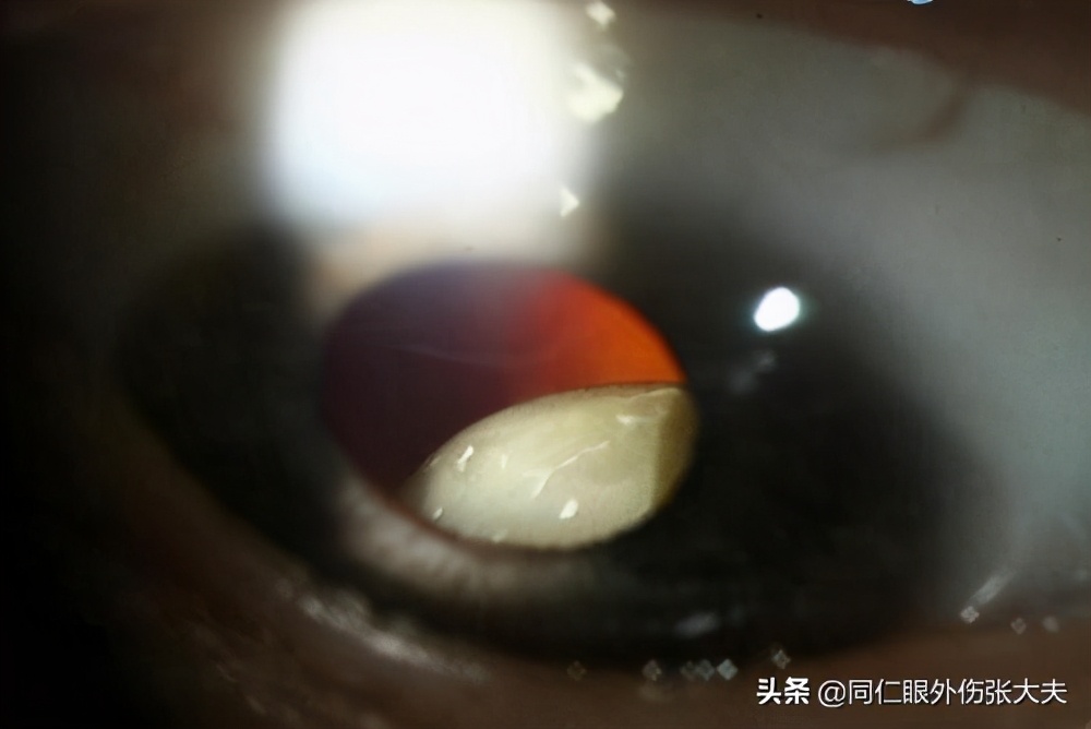 晶状体脱位的原因和治疗方法,晶状体脱位有哪些症状