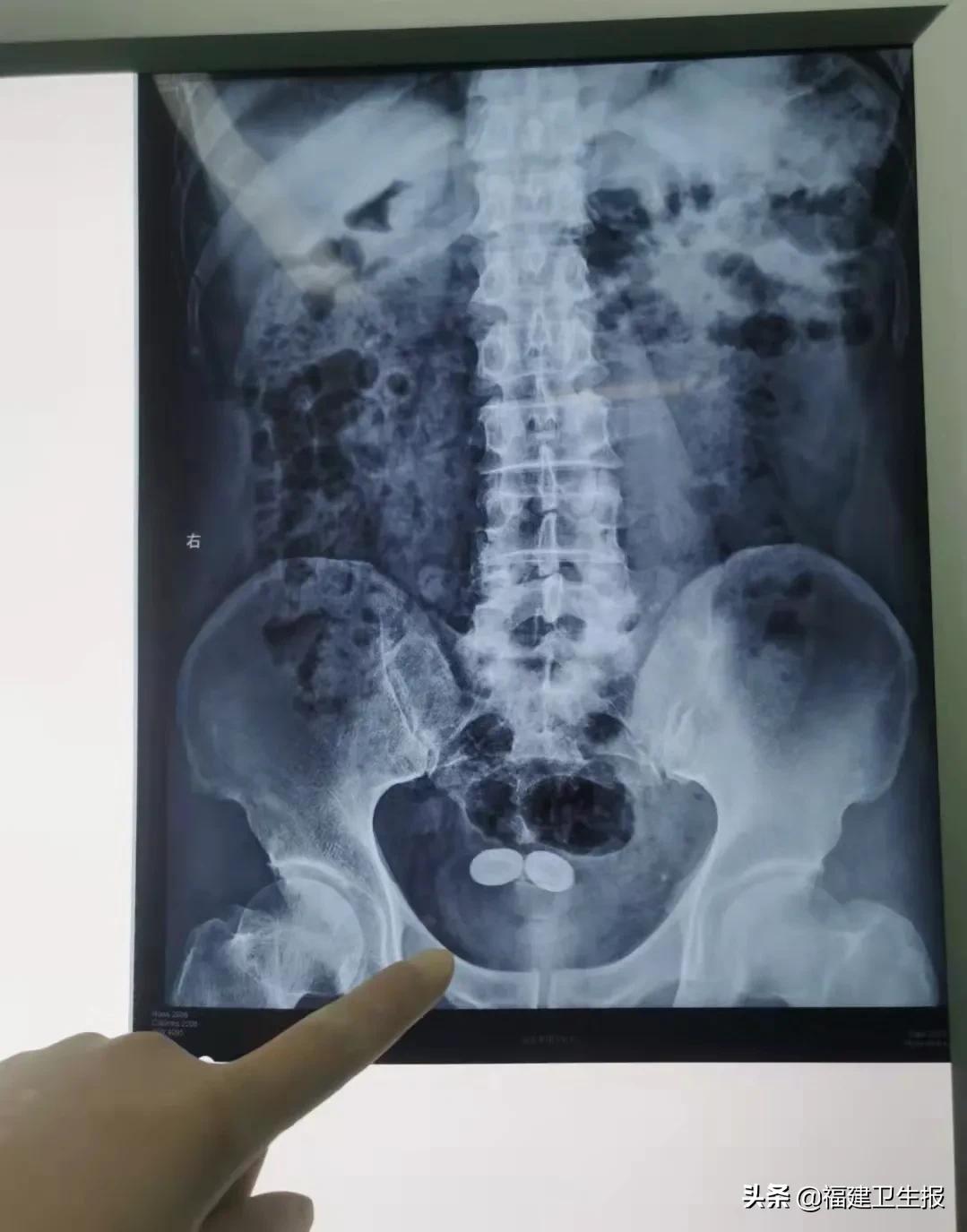 半导体激光治疗尿频尿急吗,治疗尿急尿频激光仪器