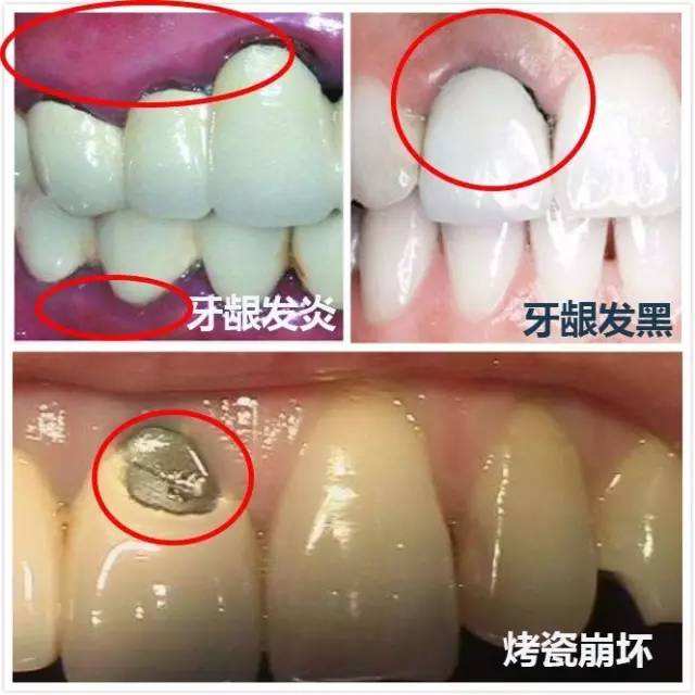 钴铬烤瓷牙边缘发黑,烤瓷牙根部发黑是什么原因