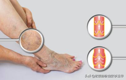 下肢静脉曲张外观不好看怎么办,下肢静脉曲张很难看怎么办
