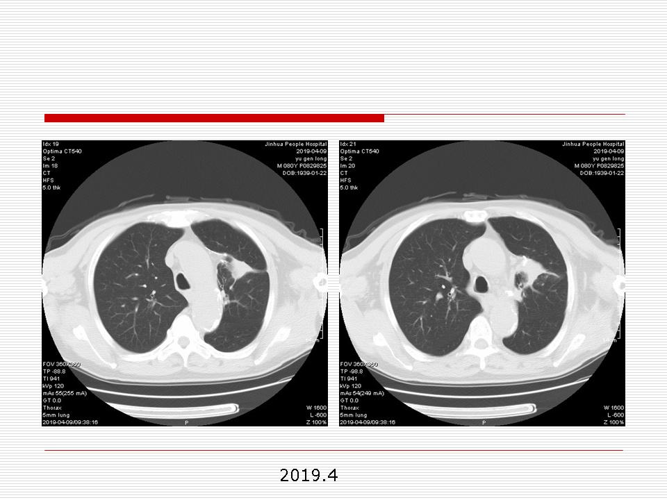 像炎症的肺癌能治好吗,医生说可能是肺癌也可能是炎症