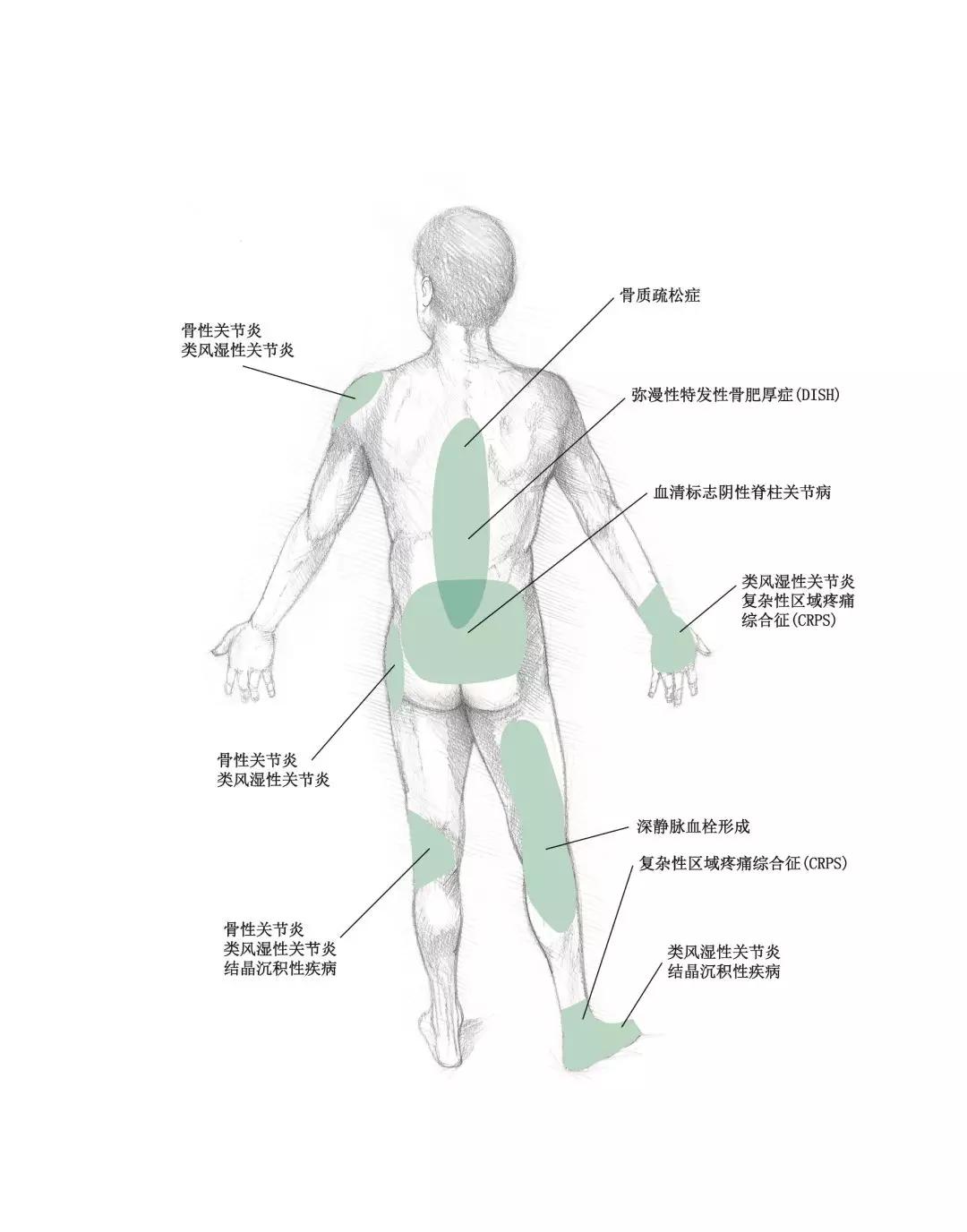 骨科十大手术疼痛排名,骨科中常见的几种疼痛