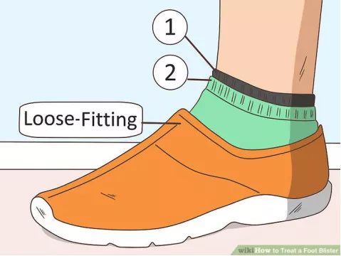 怎么预防跑步起水泡,一到夏天跑步脚就起泡怎么办