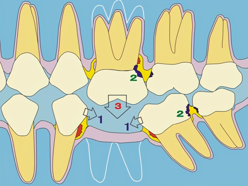种牙内幕,种植牙的猫腻在什么地方