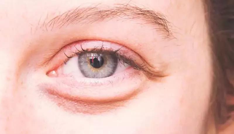 治眼袋三个小妙招快速去眼袋,上眼袋大最简单的去眼袋的方法