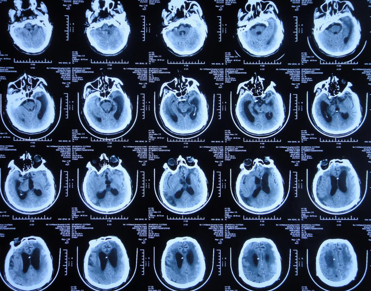 颅脑外伤术后脑积水,脑外伤脑积水颅骨缺失