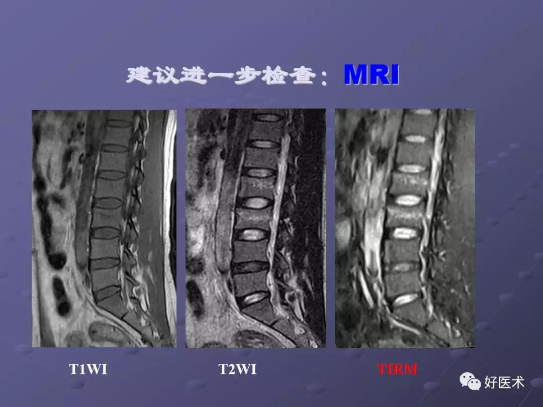 脊柱mri有哪些特点,乳腺疾病的mri诊断及鉴别