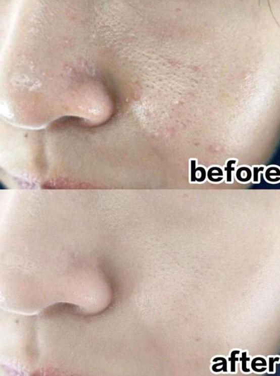 女生闭口粉刺怎么办,有闭口粉刺做什么医美